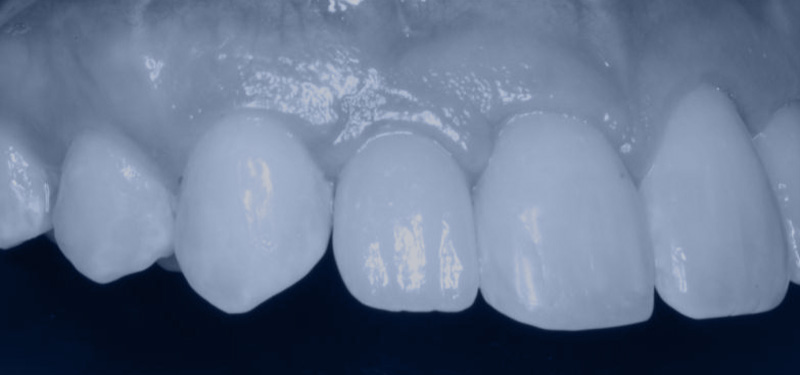 After dental implants Après les implants dentaires