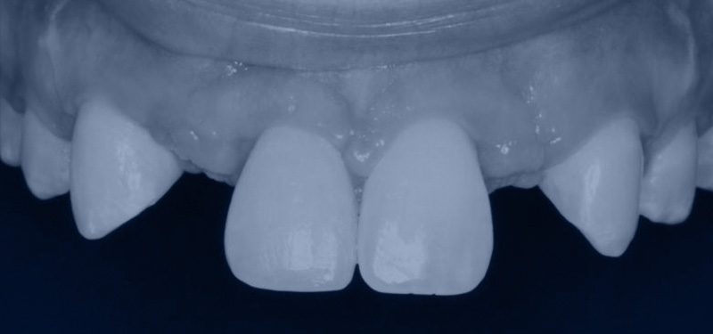 Before dental implants Avant les implants dentaires