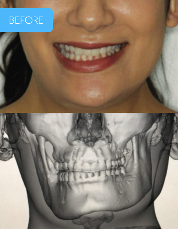 Avant et après chirurgie orthognatique chez Seaforth à Montreal Before and after from a case of orthognathic surgery