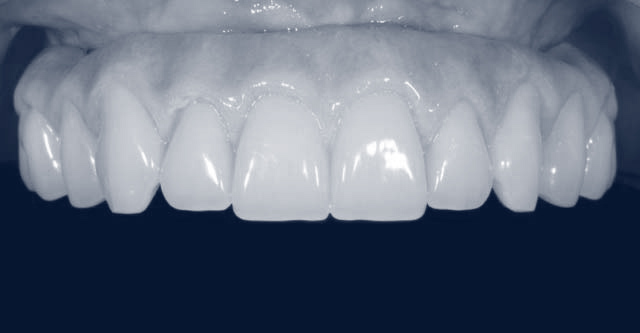 Après les implants dentaires All on 4 After All on 4 dental implants