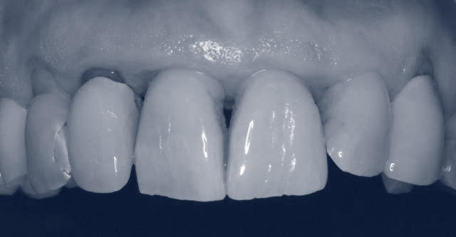 Avant les implants dentaires All on 4 Before All on 4 dental implants