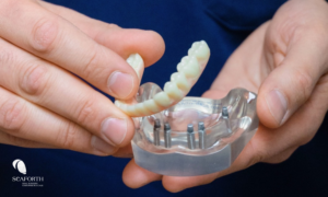 An example of an implant-supported denture.