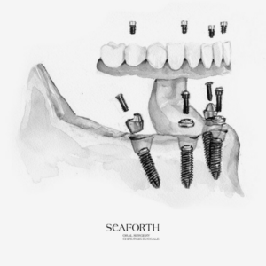 A diagram drawing showing how implant dentures are placed.