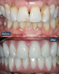 Before and after photo illustrating the successful outcome of an implant-supported denture for a patient.