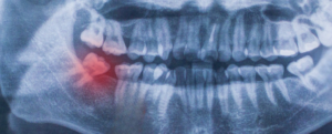 X-ray depicting what an impacted wisdom tooth is