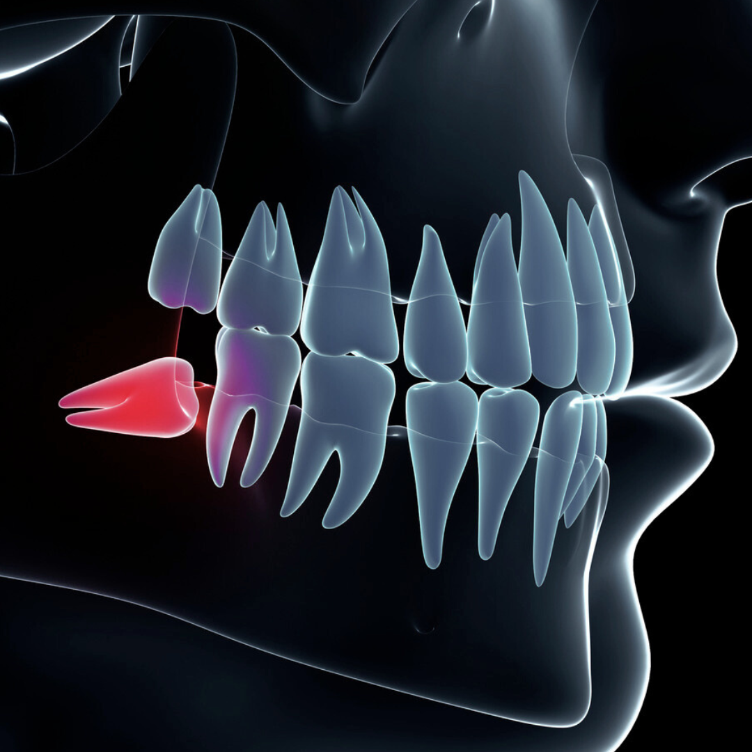 Diagram showing impacted wisdom teeth 