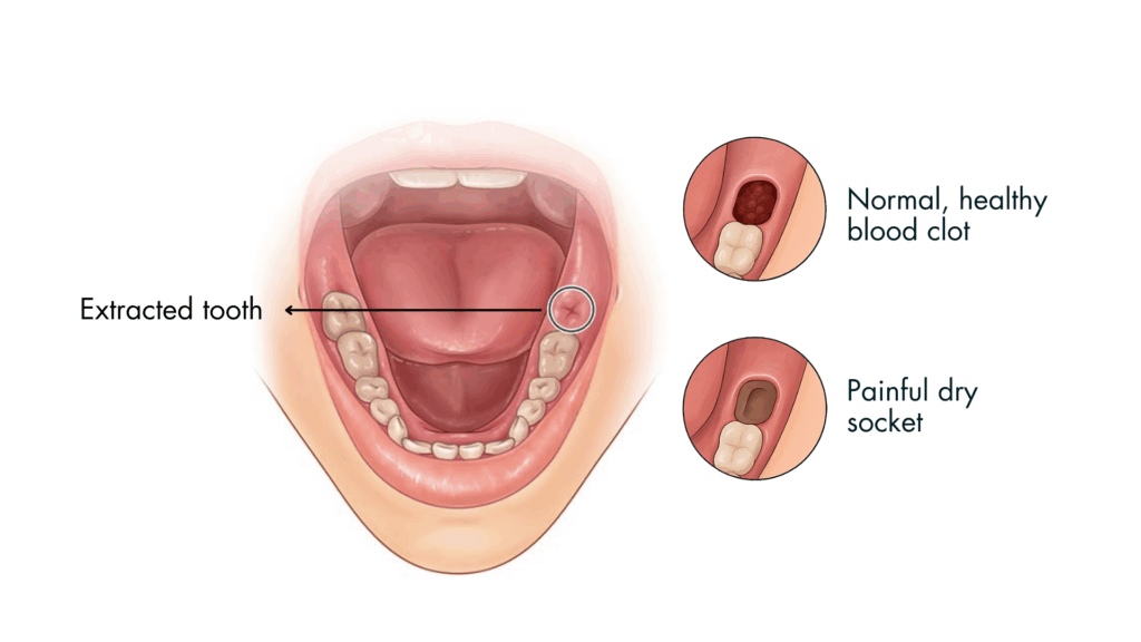 Diagram illustrating the difference in appearance between a healthy dental blood clot and dry socket.