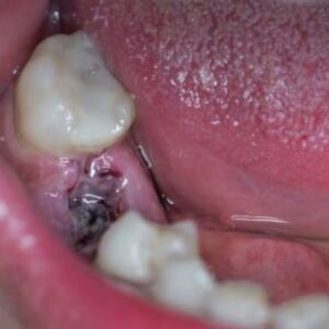 Image d'une alvéolite infectée.