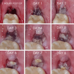 Daily evolution of a healthy tooth socket after extraction. 