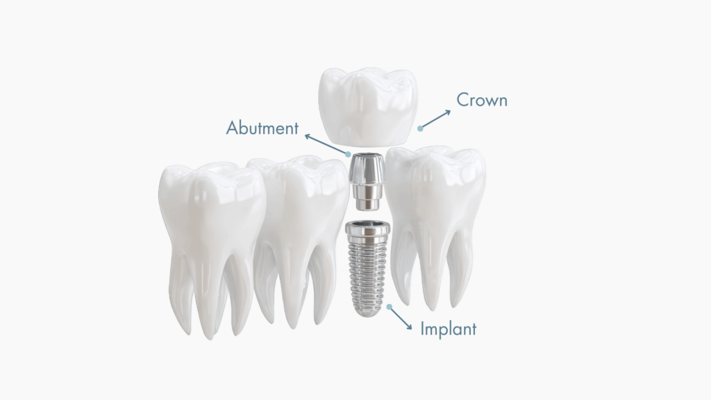 Diagram depicting components of a dental implant. 