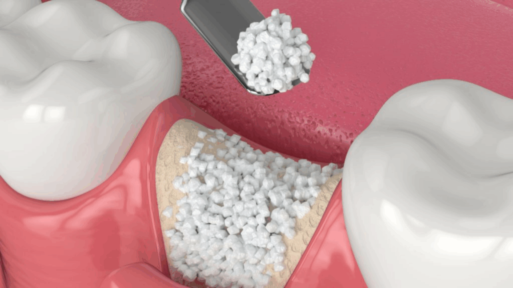 Photo depicting the mechanism of a pre-implantary bone graft 