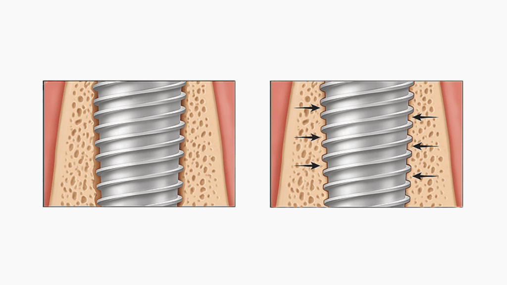 Osseointegration: natural fusion between the titanium screw and the jawbone.