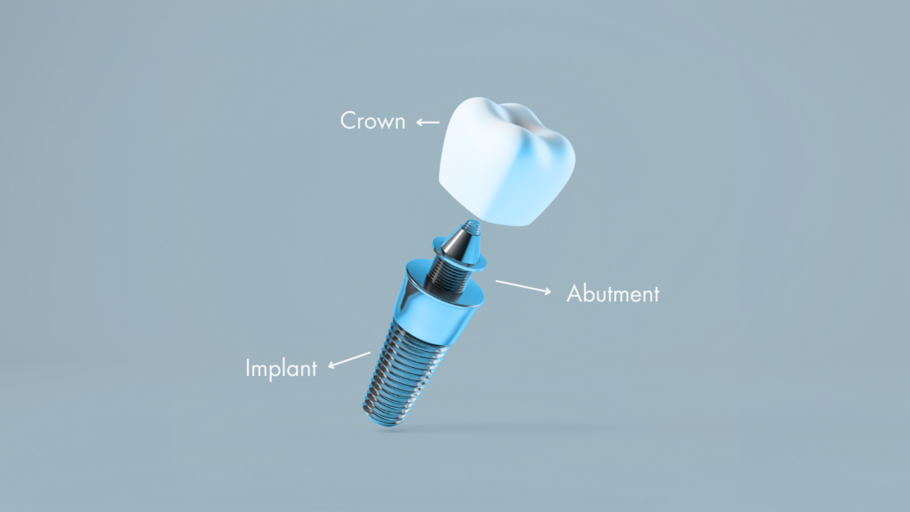 Diagram of a dental implant in Montreal showing the titanium screw, abutment, and prosthetic crown. 
