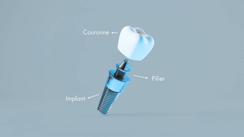 Schéma d’un implant dentaire à Montréal montrant la vis en titane, le pilier et la couronne prothétique. 