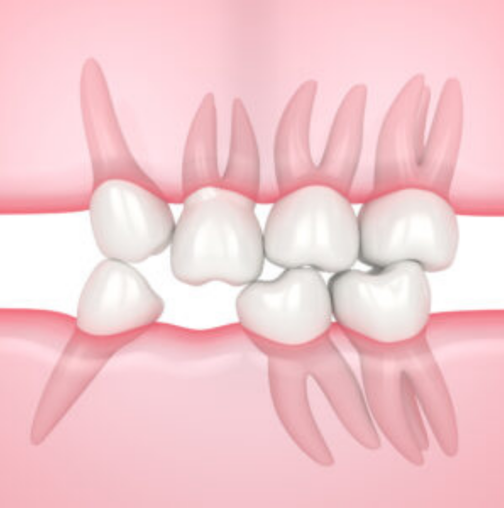 Illustration of neighbouring teeth shifting and opposing teeth over-erupting due to untreated tooth loss.