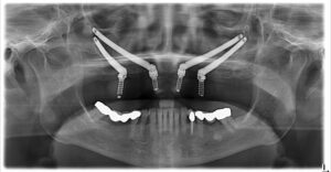 Image illustrating what zygomatic implants are