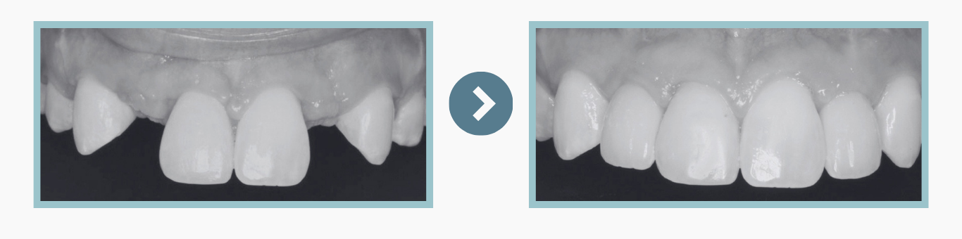 Avant et après la mise en charge immédiate d'implants dentaires antérieurs
