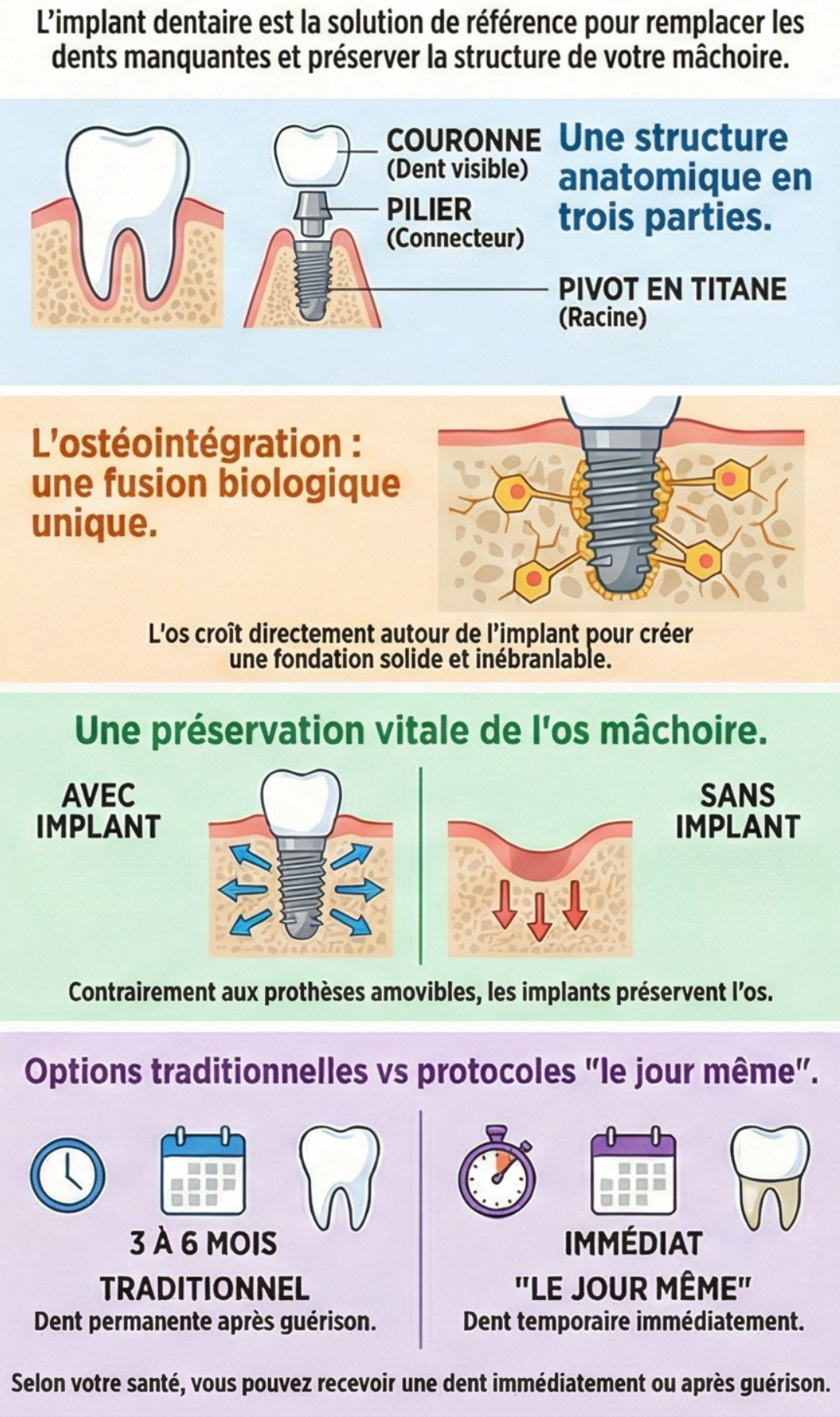 Une infographie expliquant ce que sont les implants dentaires 