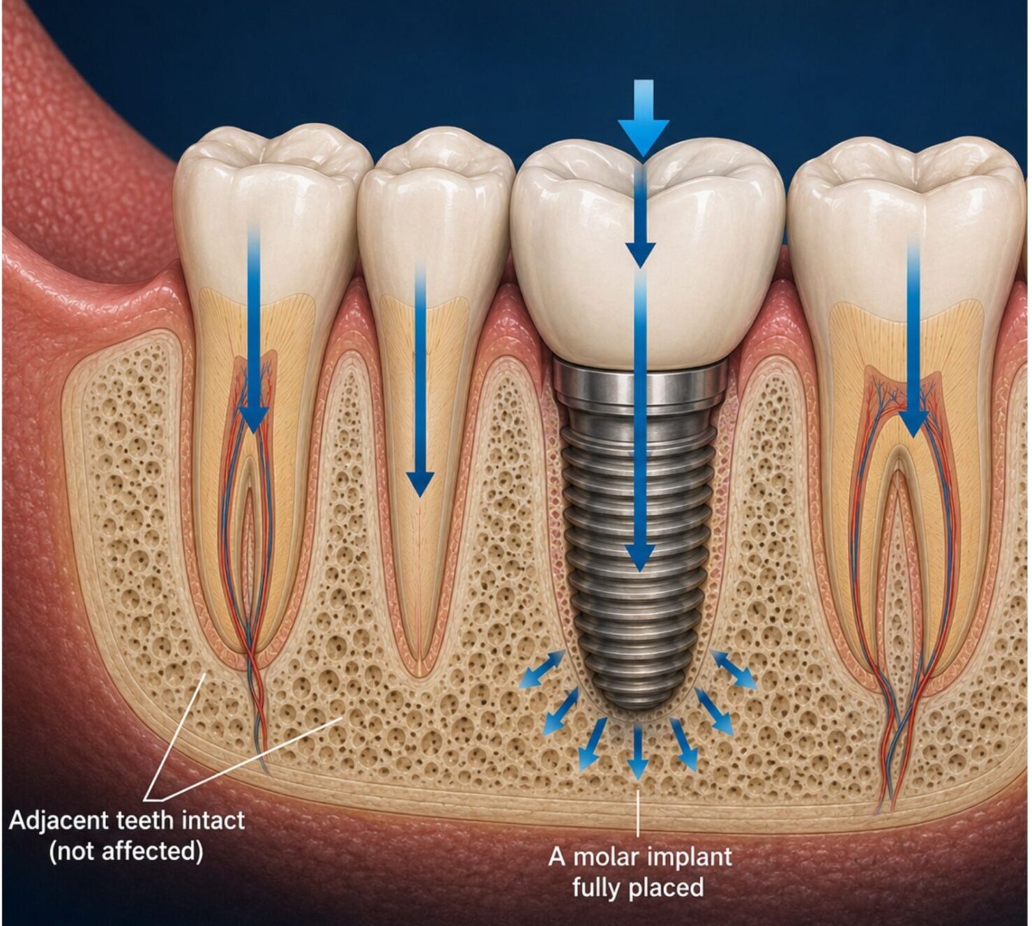 Illustration showing a molar dental implant restoring chewing forces in the jaw
