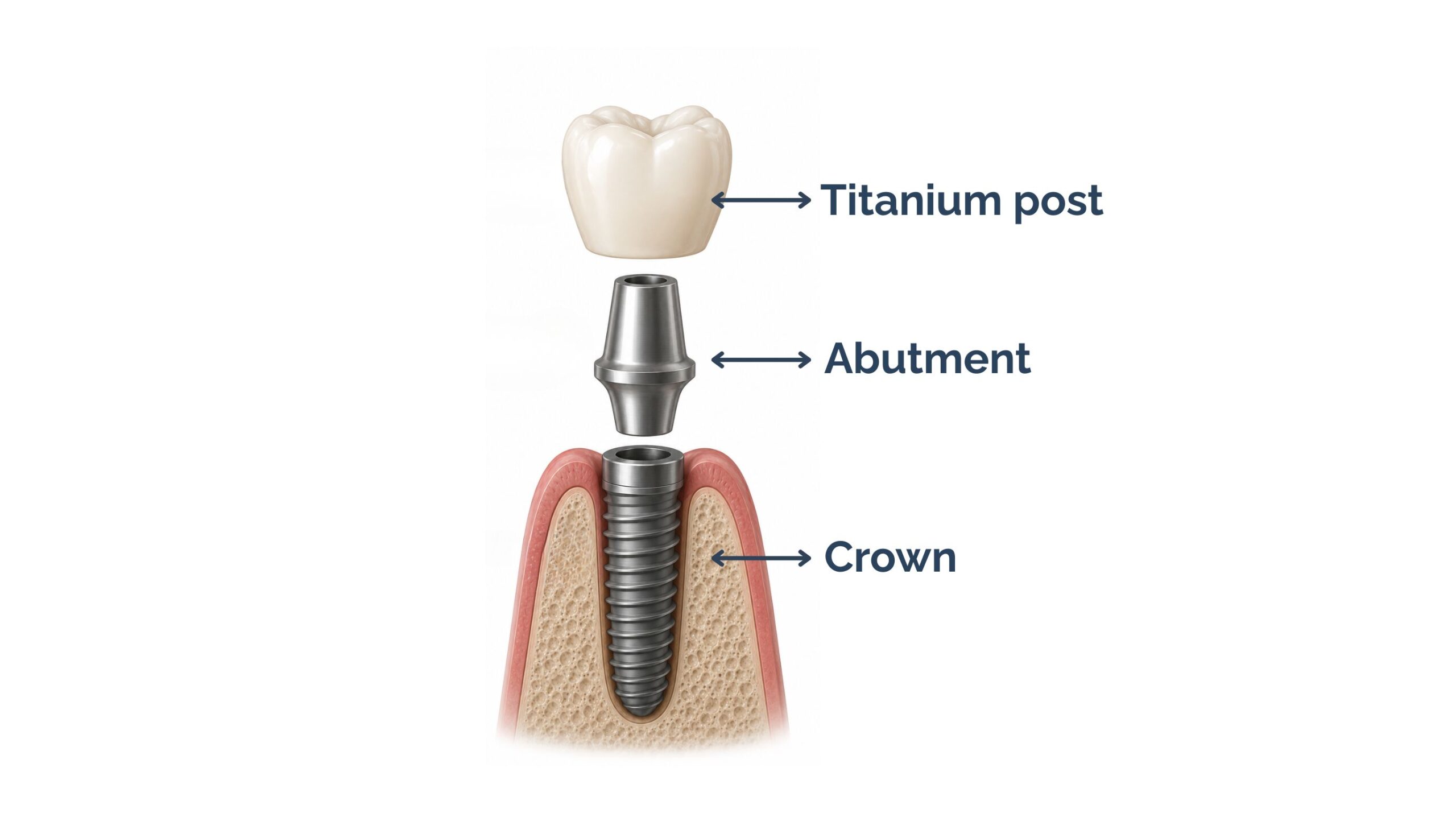 Diagram of a single tooth dental implant showing implant, abutment, and crown