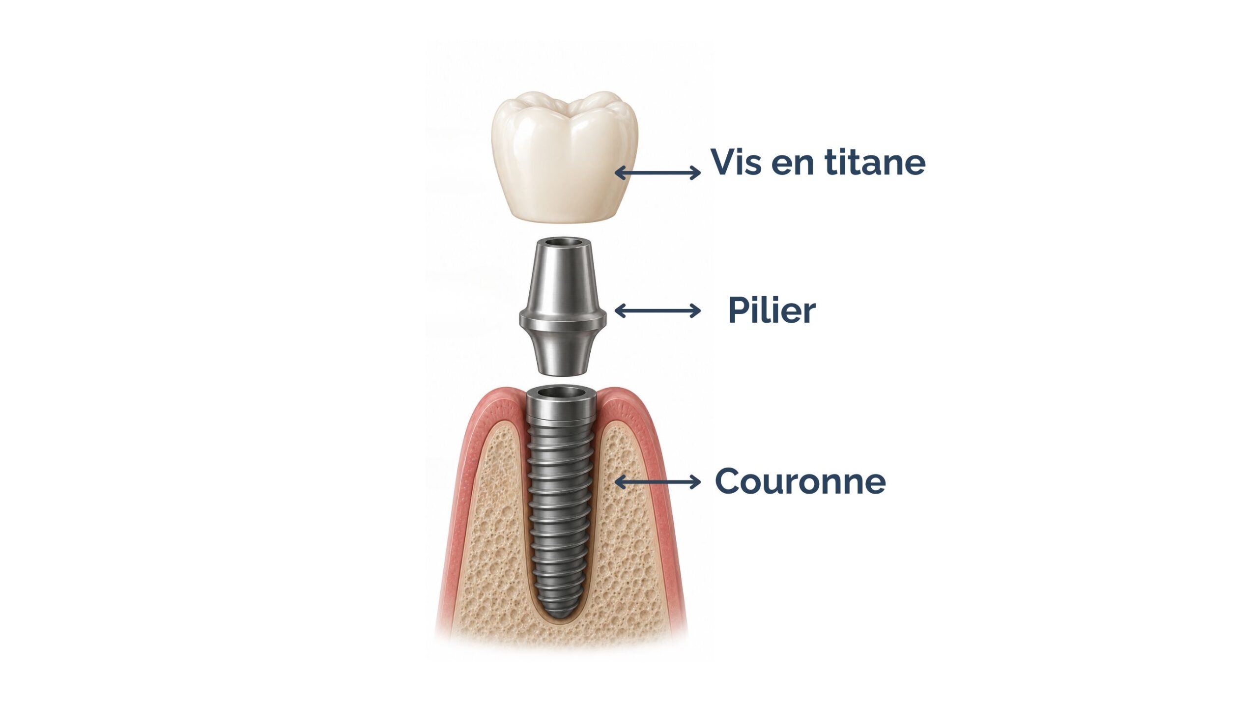 Schéma d’un implant dentaire montrant la vis, le pilier et la couronne 