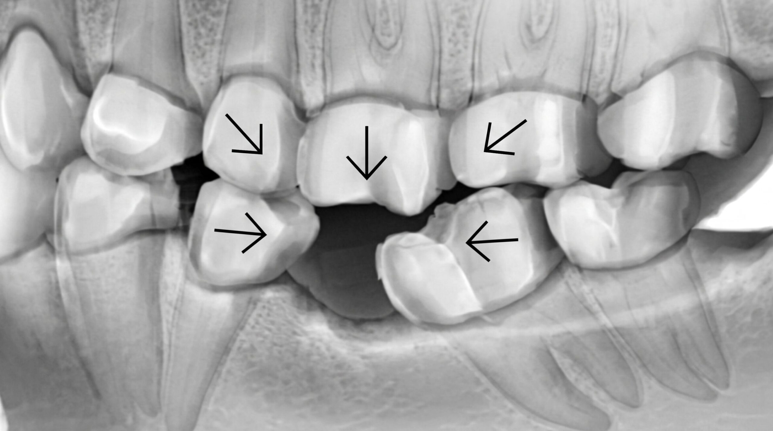 Diagram showing teeth shifting after a missing tooth 