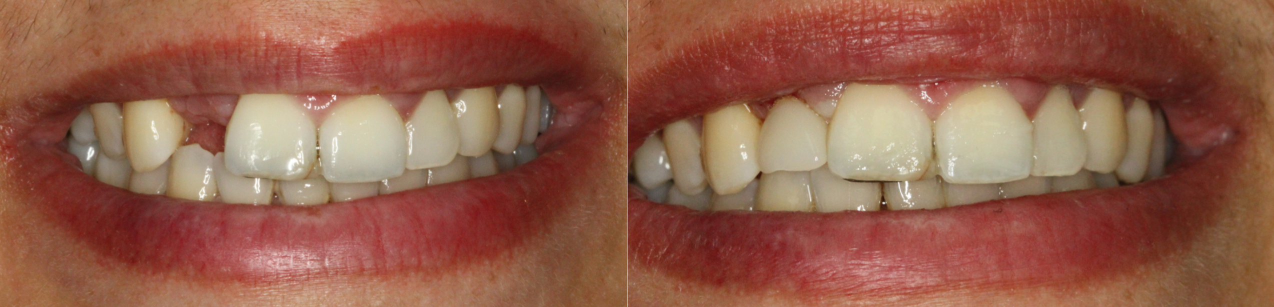 Before and after dental implant smile restoration showing replacement of missing teeth and improved smile appearance