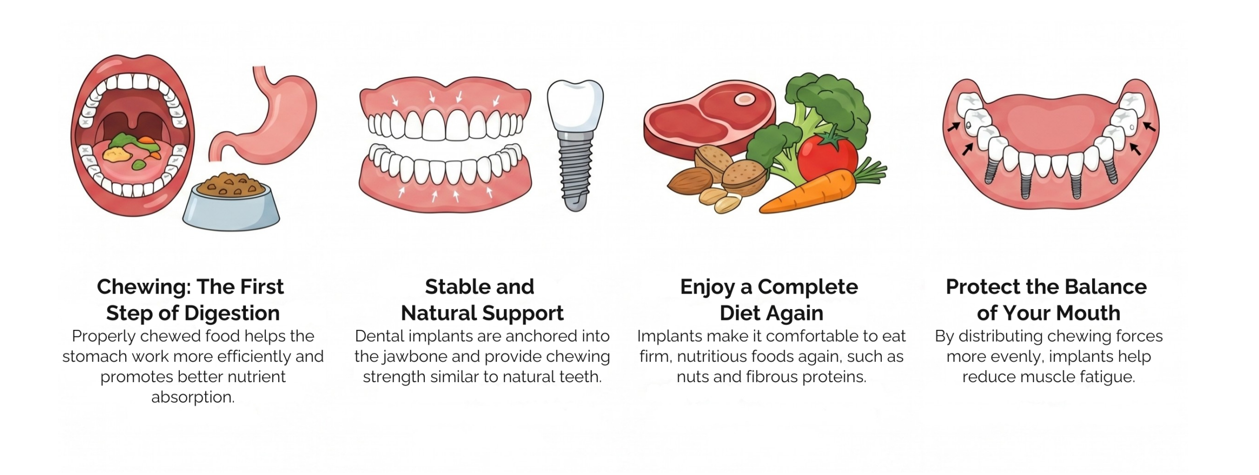 Infographic explaining how dental implants can improve digestion and overall nutrition for people wearing removable dentures 