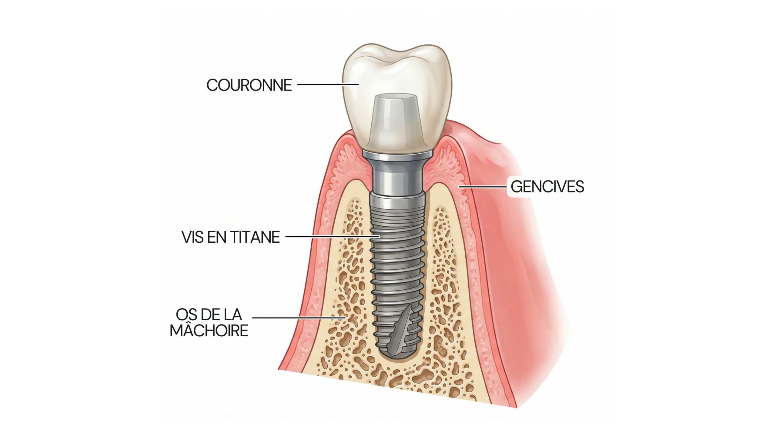 Schéma montrant la structure d’un implant dentaire, de la couronne et de l’os de la mâchoire