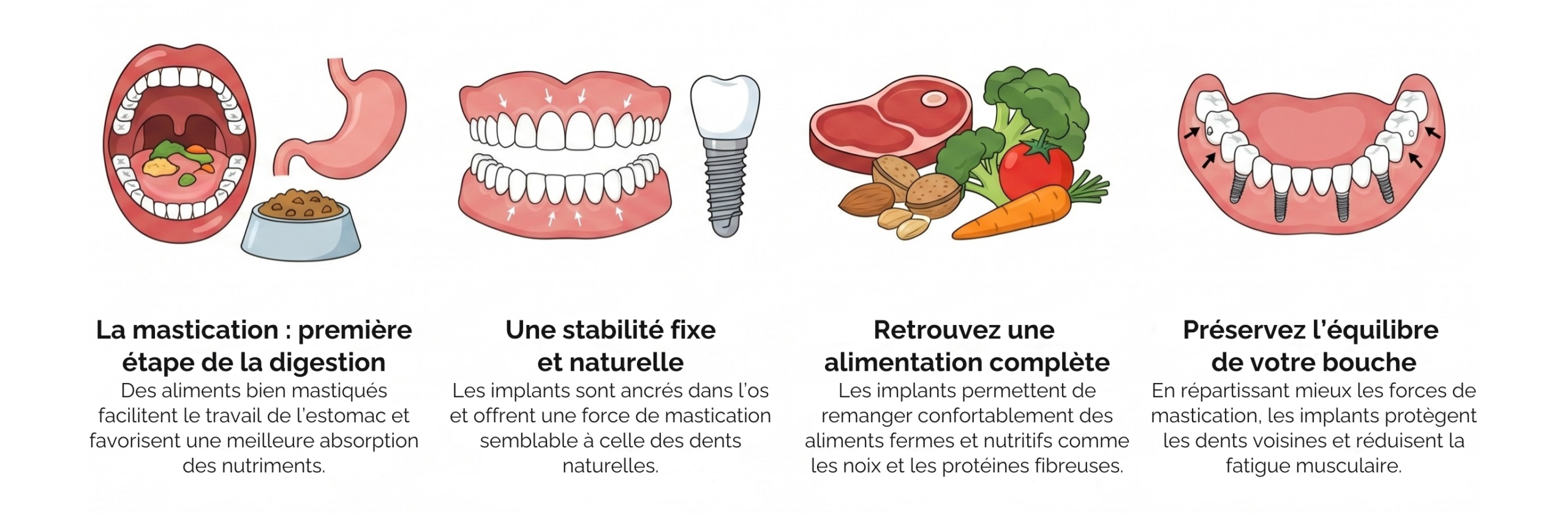Infographie expliquant comment les implants dentaires peuvent améliorer la digestion et la nutrition globale chez les personnes portant des prothèses dentaires amovibles.