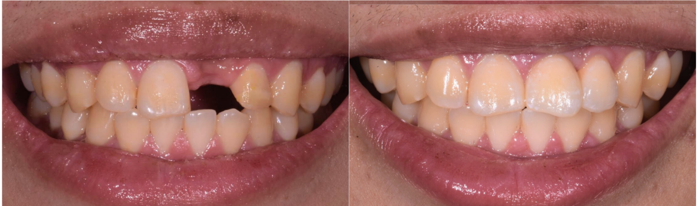 Restauration complète All-on-X soutenue par implants offrant des dents fixes de remplacement 