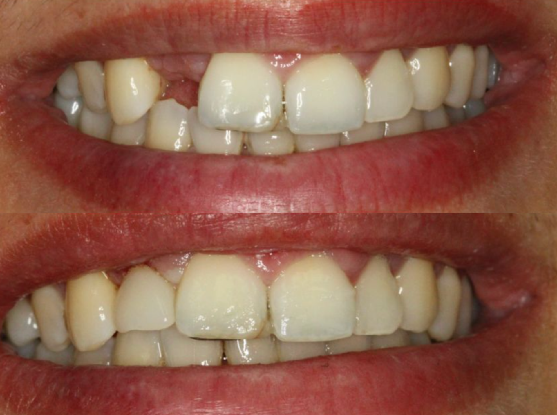 Before and after dental implant treatment for a missing tooth