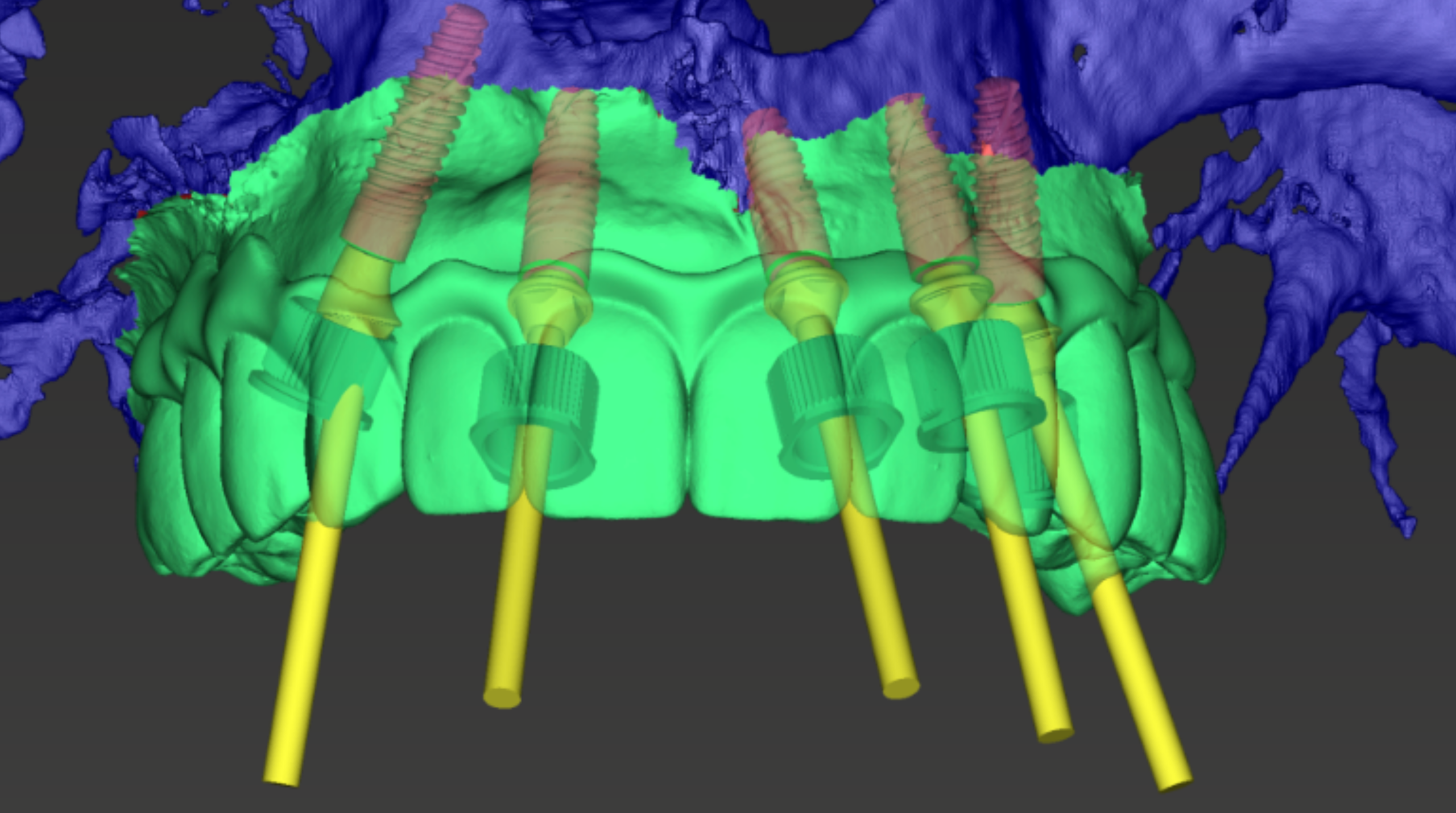 Oral surgeon reviewing a CBCT scan for dental implant planning 