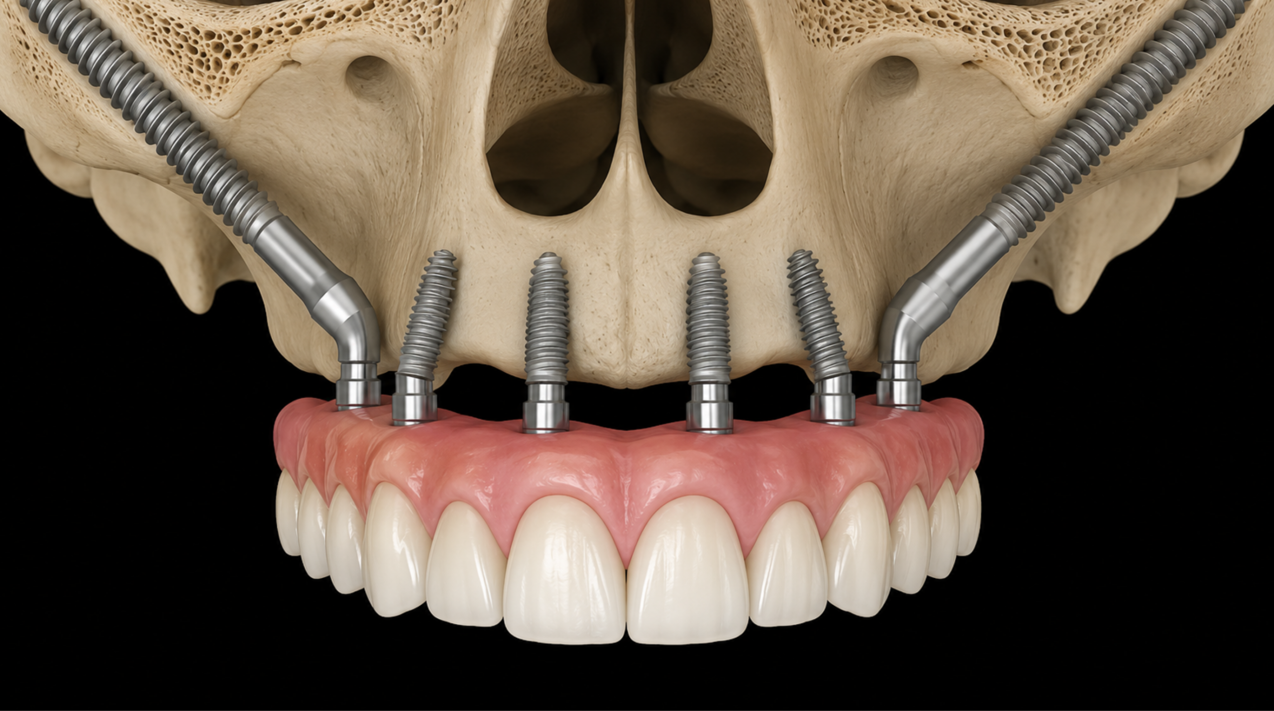 Implants dentaires zygomatiques ancrés dans l’os zygomatique chez les patients présentant une perte osseuse importante 