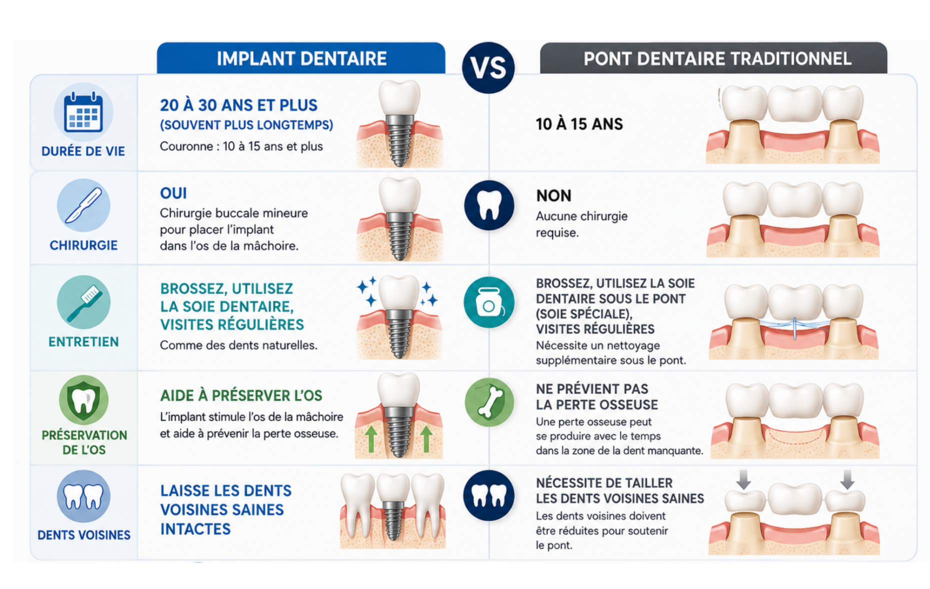 Comparaison côte à côte entre un implant dentaire et un pont dentaire traditionnel.