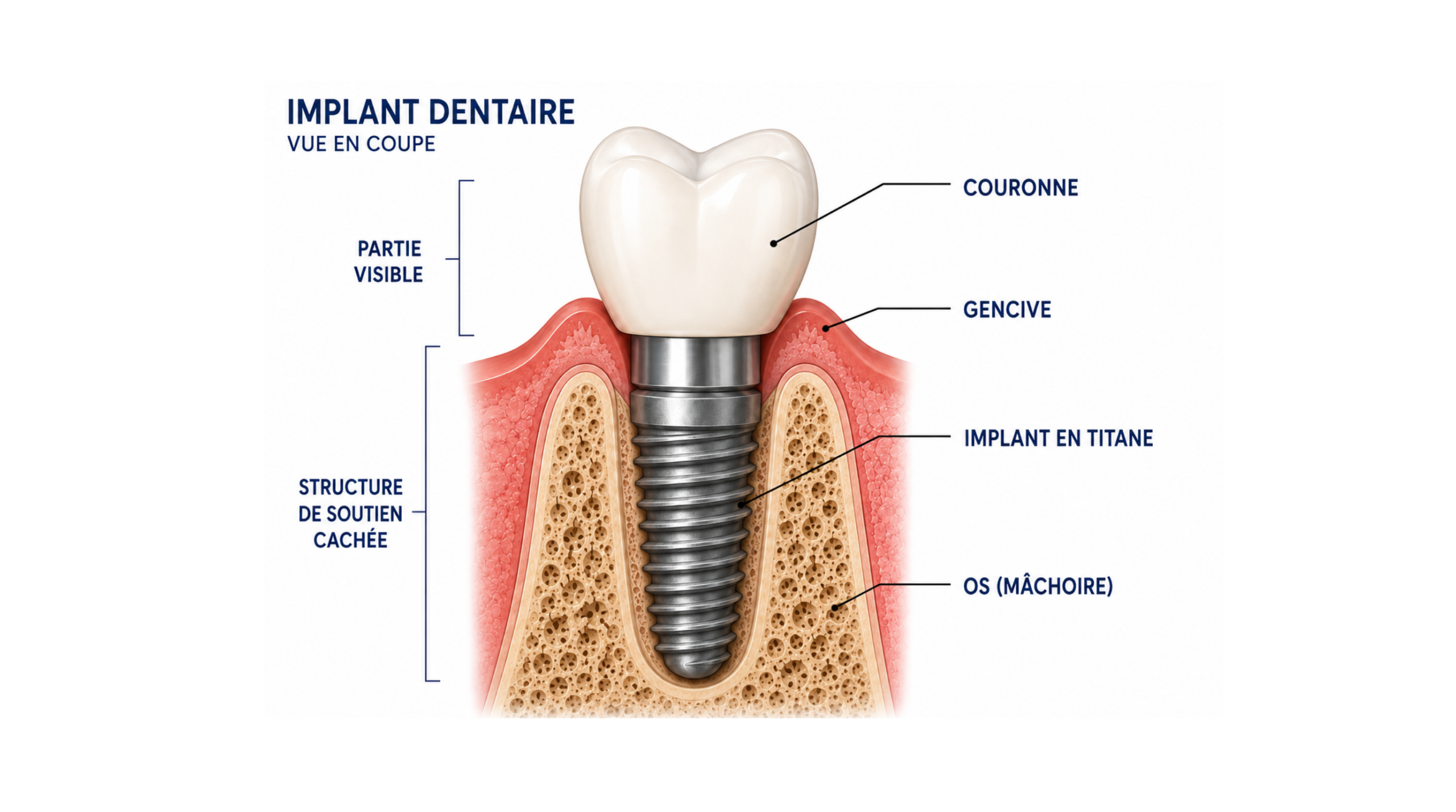 Coupe anatomique montrant un implant dentaire intégré à l'os de la mâchoire.