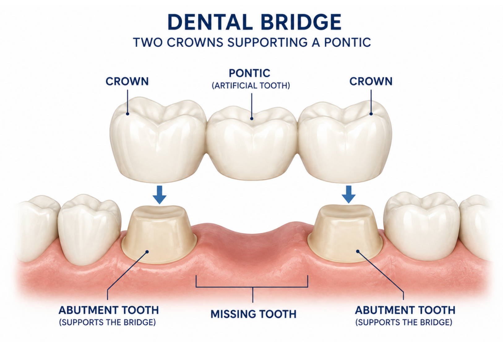 Illustration showing how a traditional dental bridge replaces a missing tooth. 