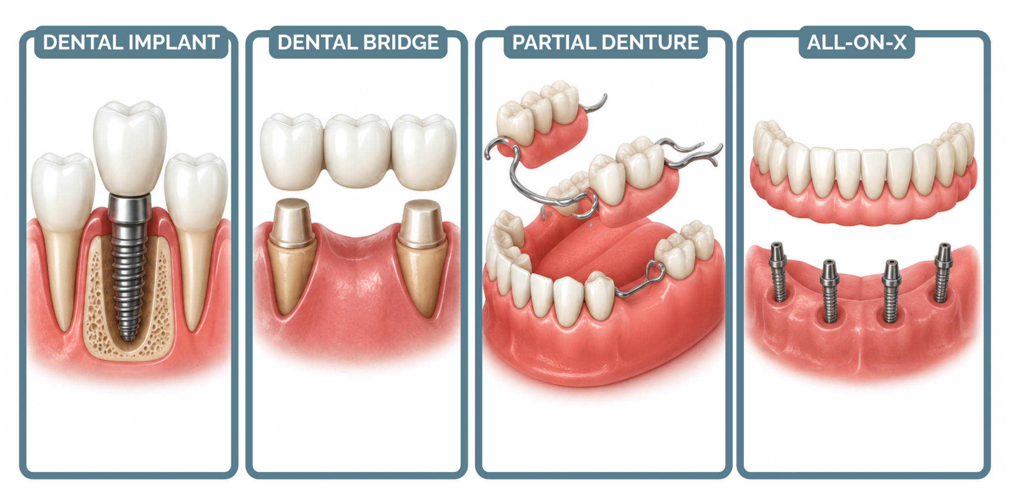 Illustration comparing common options for replacing a missing tooth.