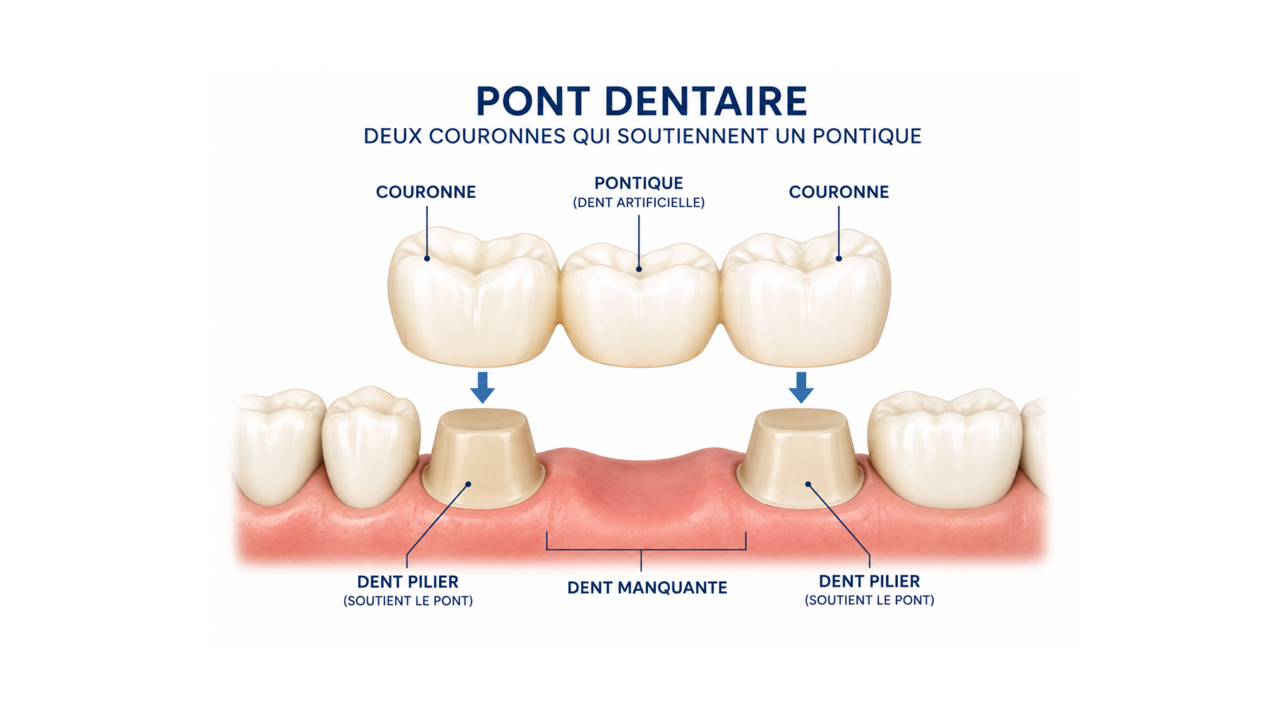 Illustration montrant le fonctionnement d'un pont dentaire traditionnel.