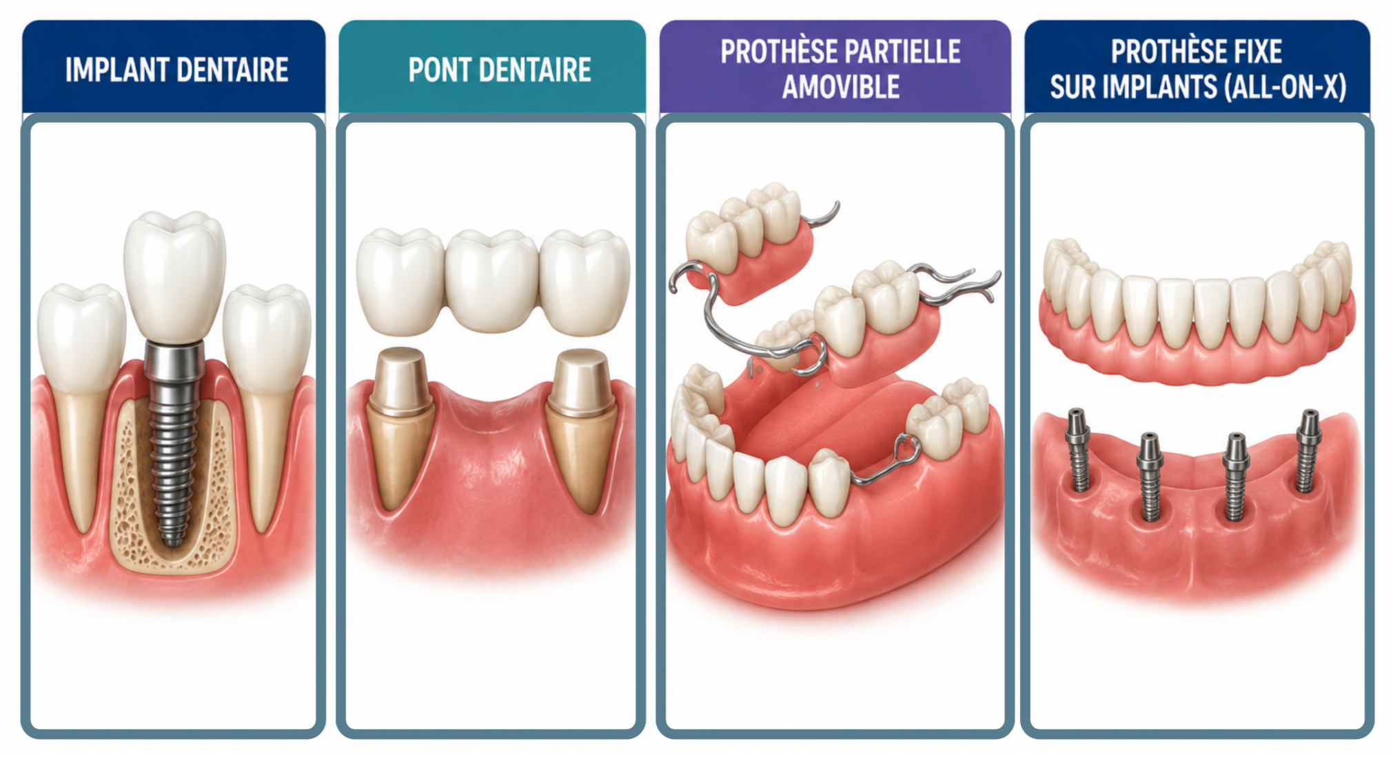 Illustration comparant les principales options pour remplacer une dent manquante.