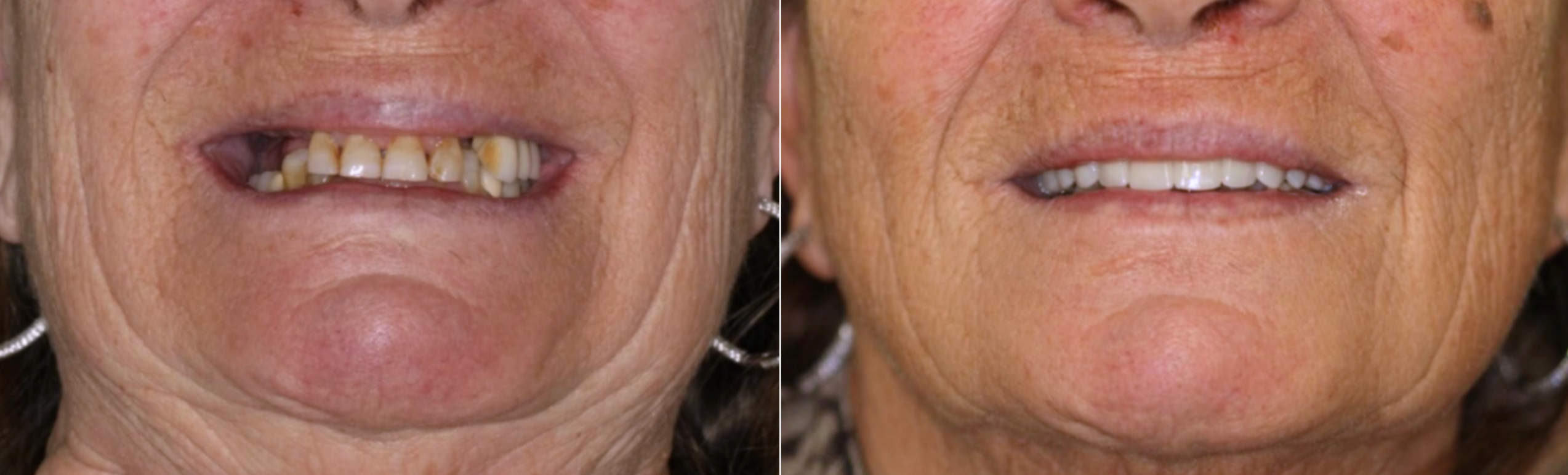 Before and after of a dental implant All-on-4 patient. 