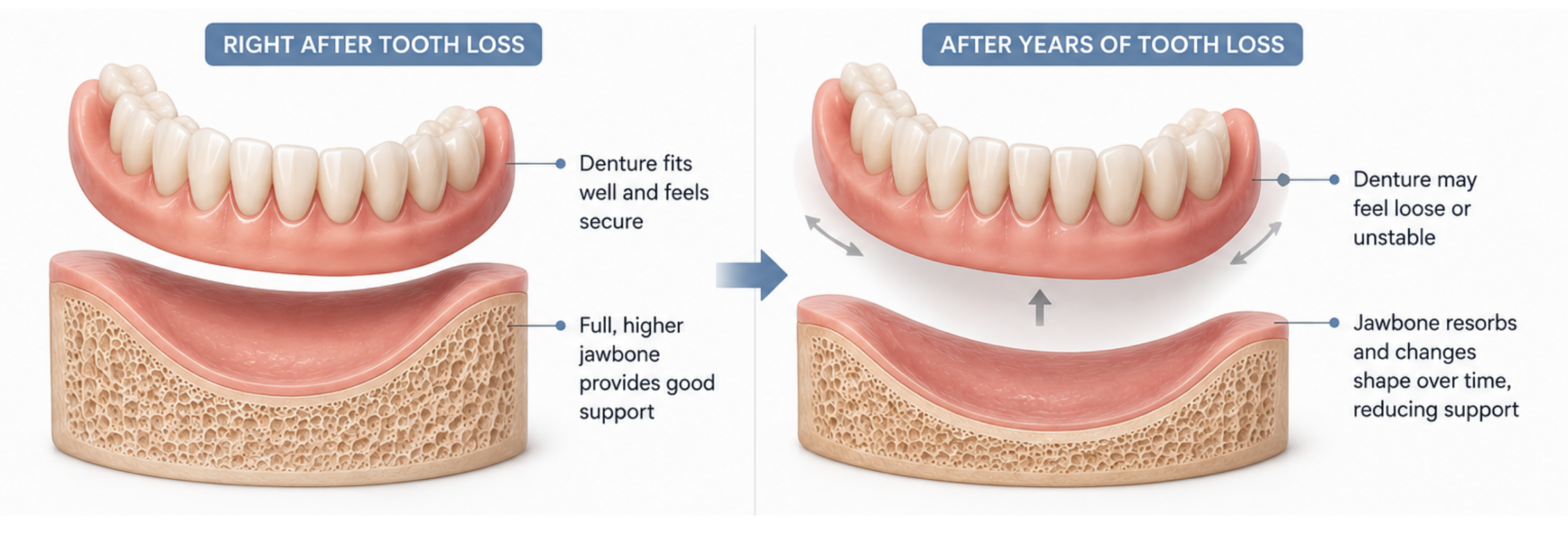 Illustration showing jawbone changes that can affect denture fit over time