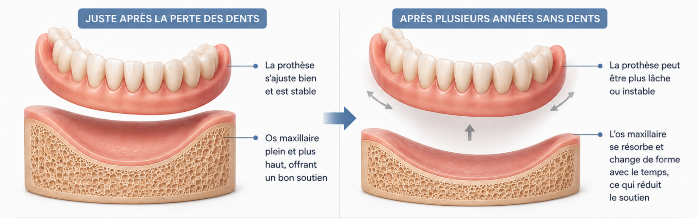 Illustration montrant les changements de l’os de la mâchoire pouvant affecter l’ajustement d’un dentier avec le temps