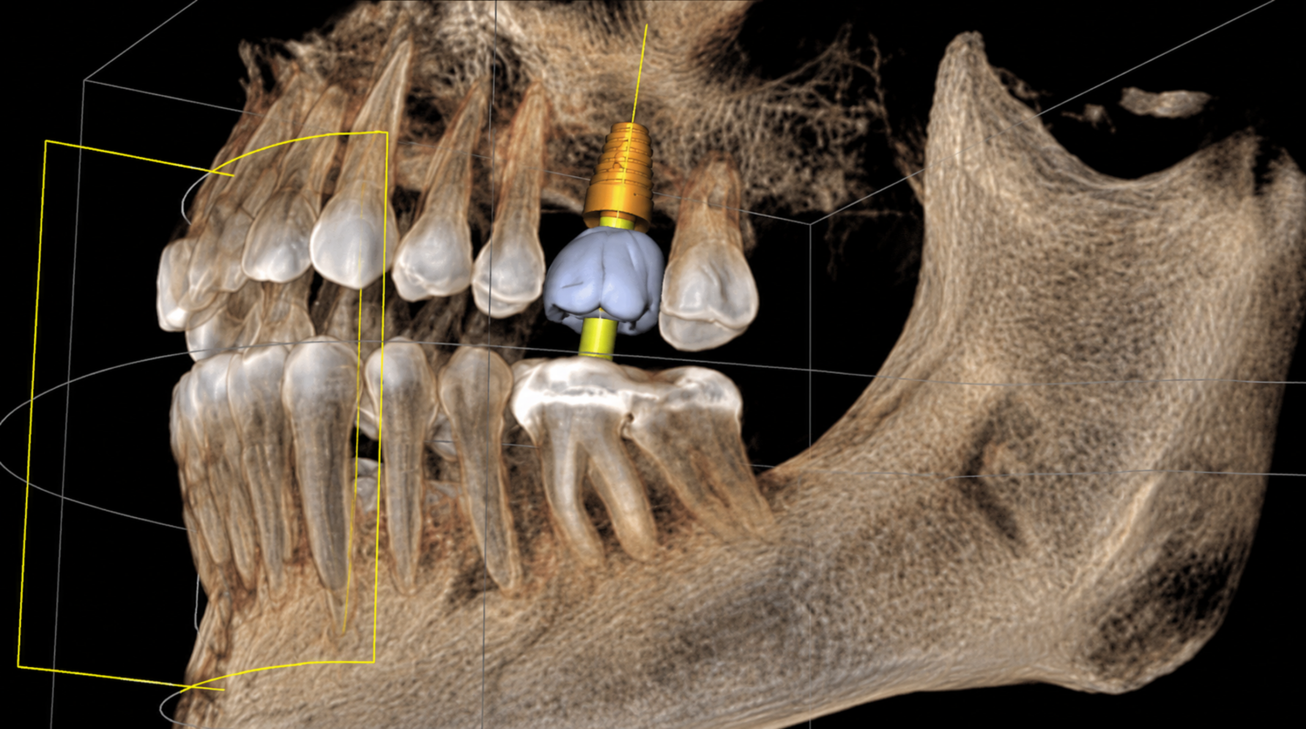 Imagerie dentaire 3D utilisée pour évaluer l’os de la mâchoire avant la pose d’un implant dentaire