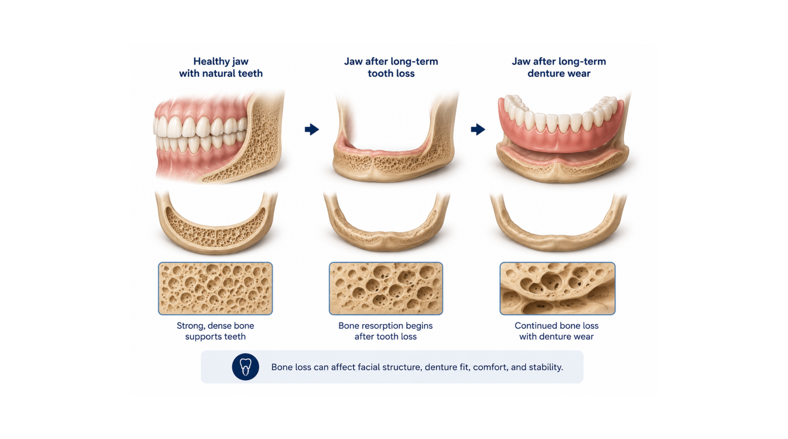Illustration of jawbone changes after long-term tooth loss and denture wear