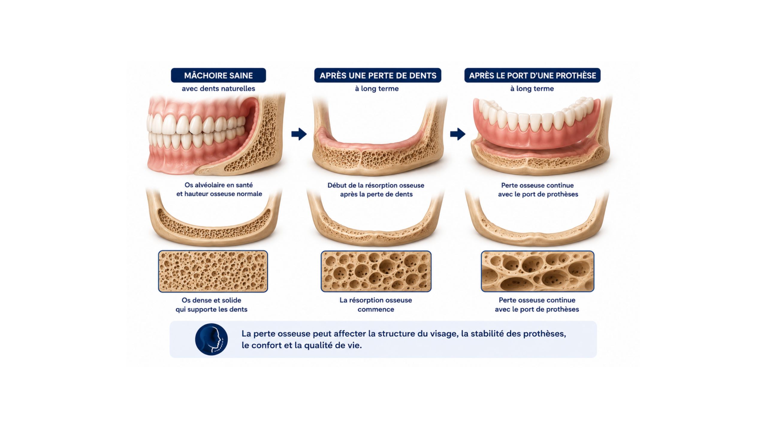 Illustration des changements de l’os de la mâchoire après une perte de dents prolongée et le port d’un dentier