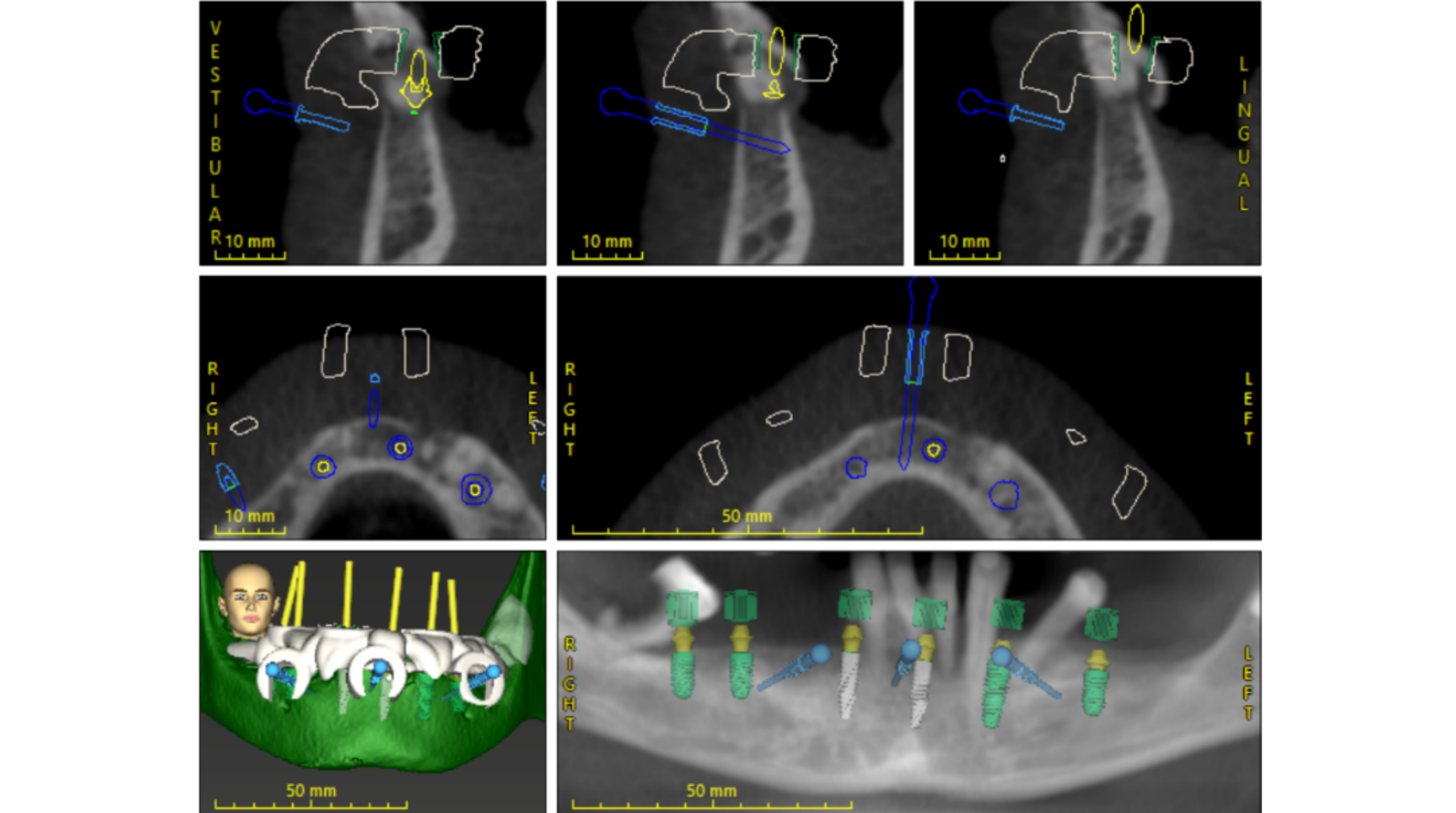 Restauration complète All-on-X soutenue par plusieurs implants dentaires