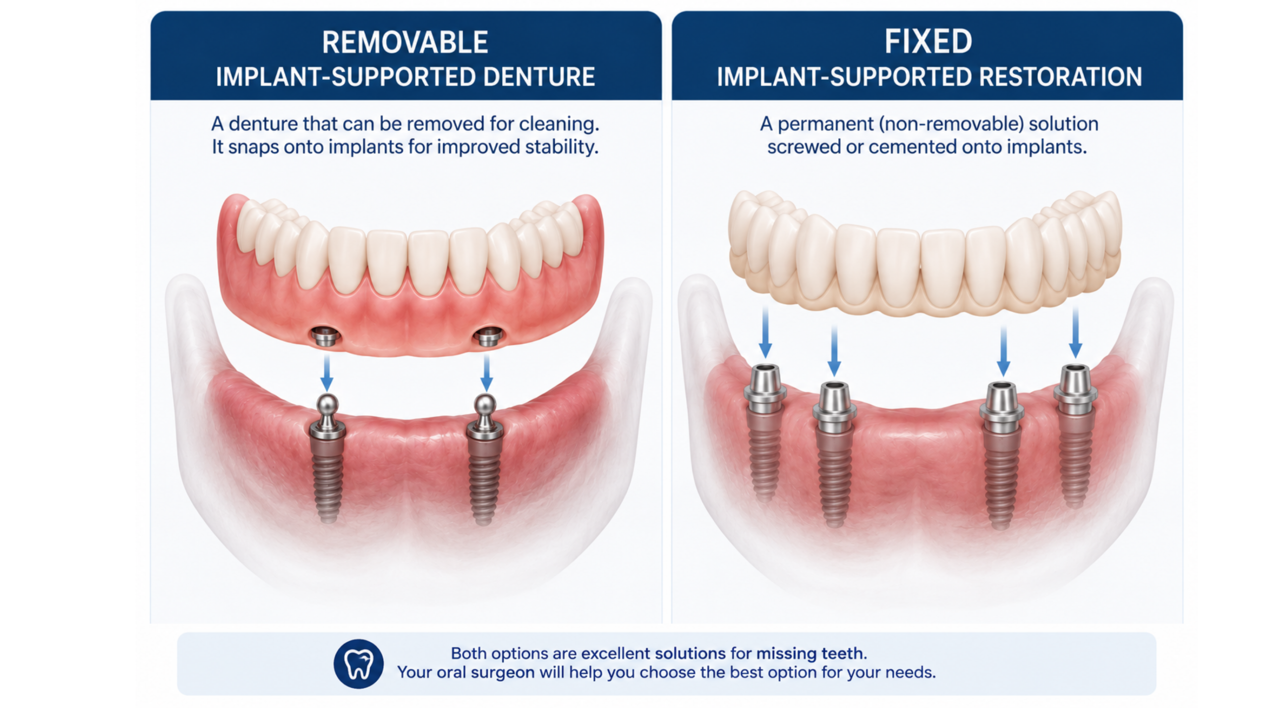 Comparison of a removable implant-supported denture and a fixed implant-supported restoration
