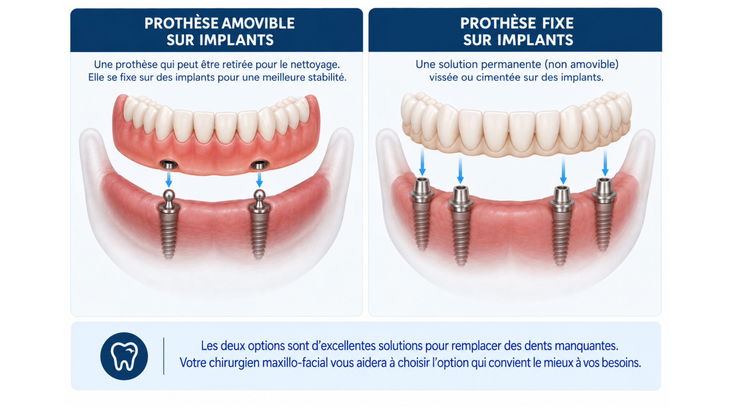 Comparaison entre une prothèse amovible sur implants et une restauration fixe sur implants