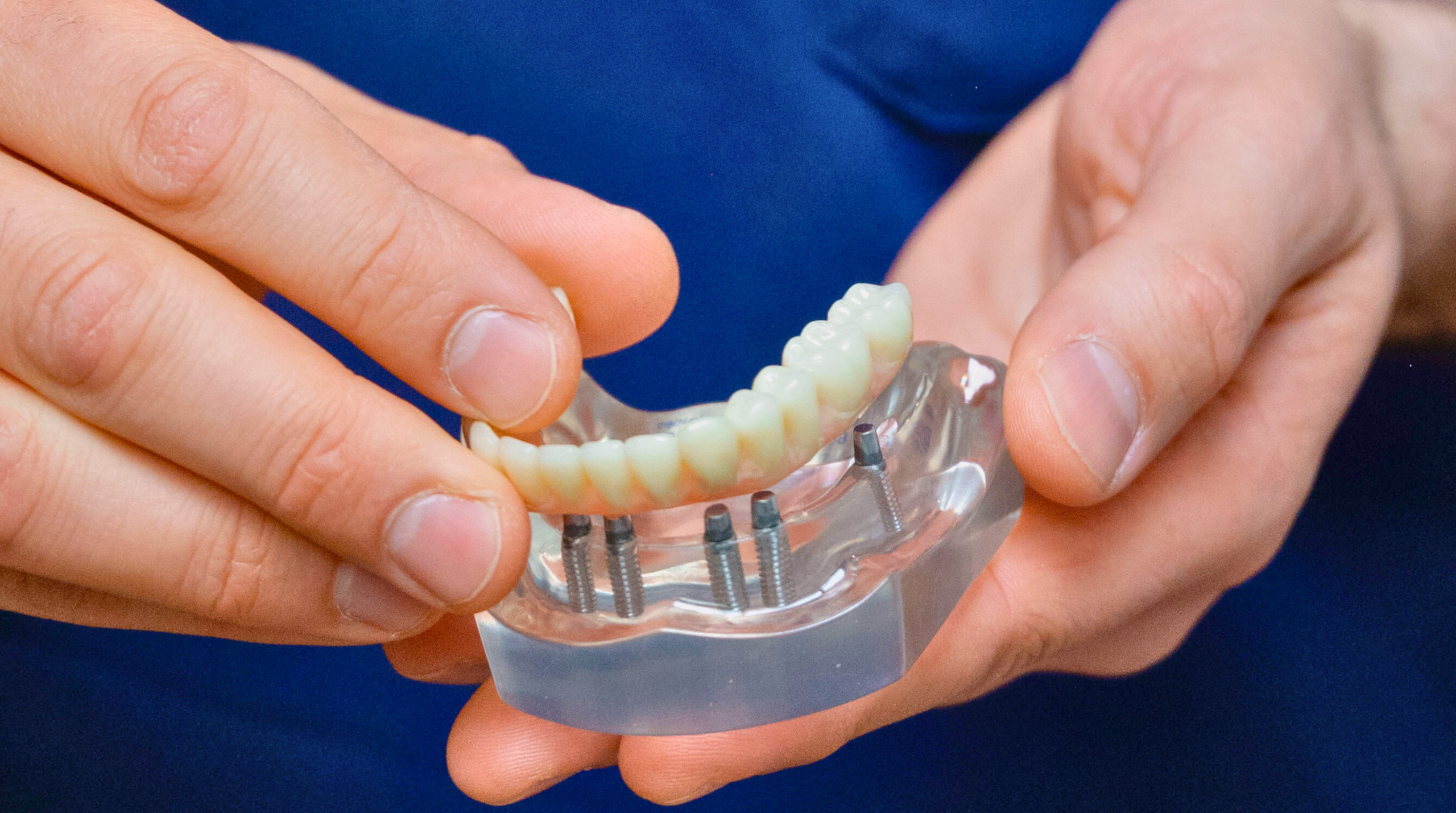 Restauration dentaire complète All-on-X soutenue par plusieurs implants dentaires